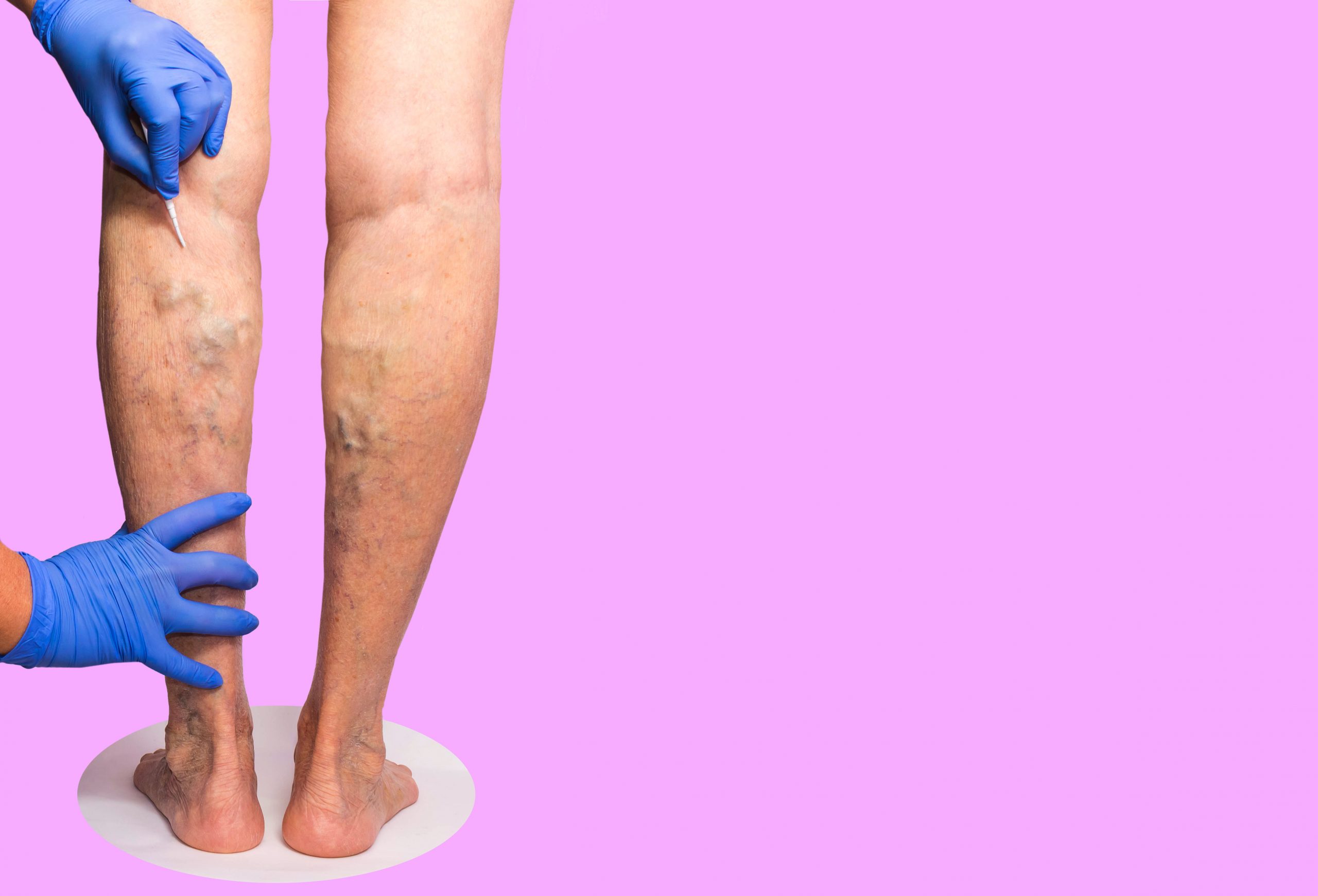 What Do Vein Centers Do? When To See A Vascular Doctor