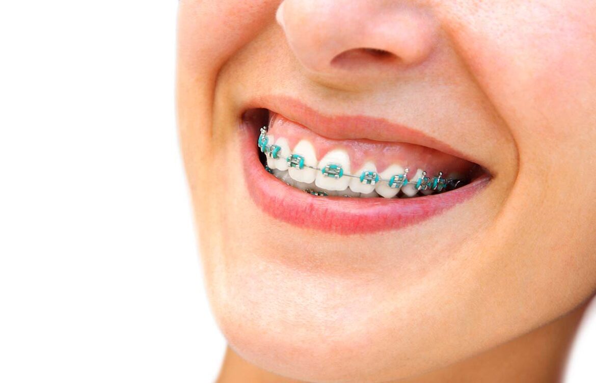 Best Orthodontist In Miami, FL: Are Braces Near Me The Solution For My Smile?