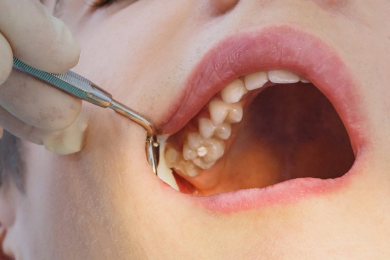 What Are The Advantages Of Treatment For Periodontal Disease?