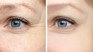 What Are The Advantages And Costs Of Eye Lift And Laser Fat Removal Procedures?