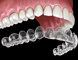 Looking For Teeth Cleaning In Houston? How Do Clear Aligners Near Me Offer An Advantage?