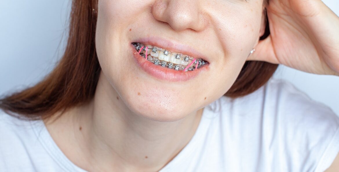 What Are The Best Brace Band Colors For Orthodontic Appliances?