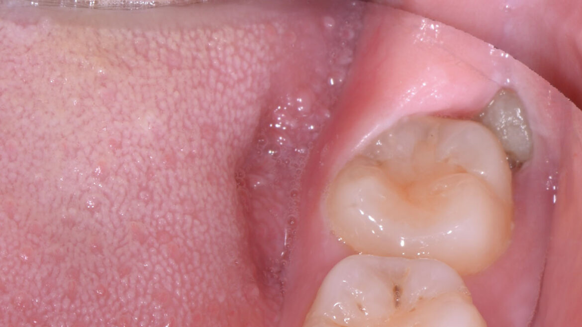 How Effective Are Implant-Supported Dentures In Wisdom Teeth Extraction Recovery?