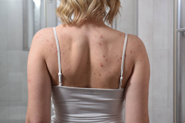 Banishing Back Acne: Causes, Symptoms, and Treatment