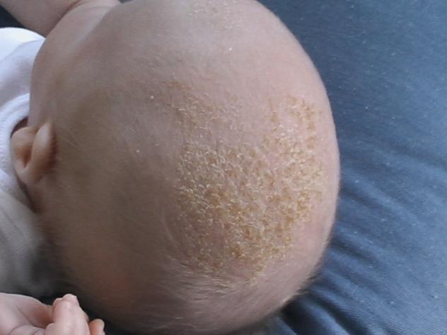 Clearing the Flakes: Tips for Dealing with Cradle Cap in Babies Introduction to Cradle Cap
