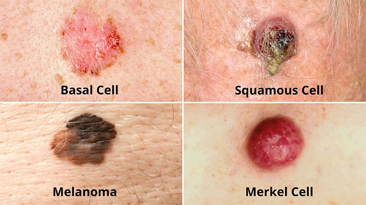 How do you know if your skin is infected with skin cancer